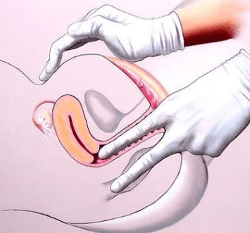 Гинекологический массаж