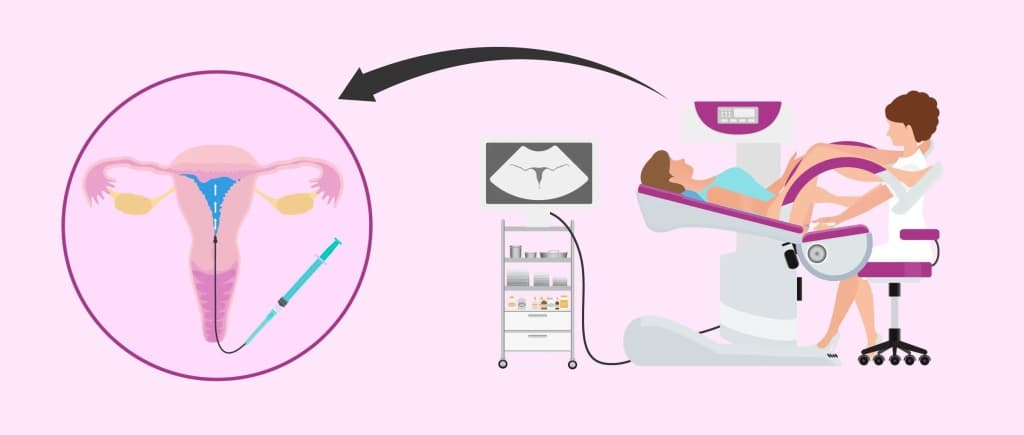 Непроходимость маточных труб