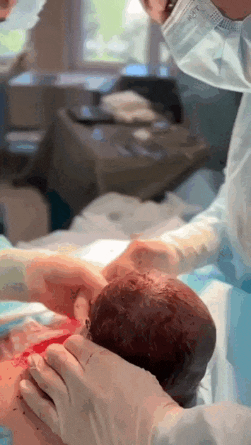Извлечение ребенка - кесарево сечение gif Извлечение ребенка - кесарево сечение gif