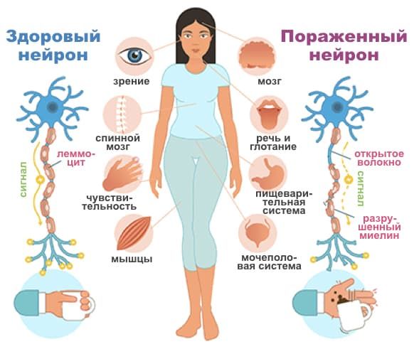 Рассеянный склероз после родов