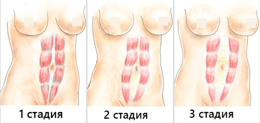 Схема классификации диастаза