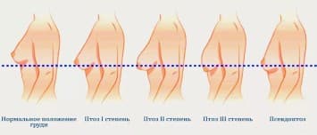 Упругость кожи груди