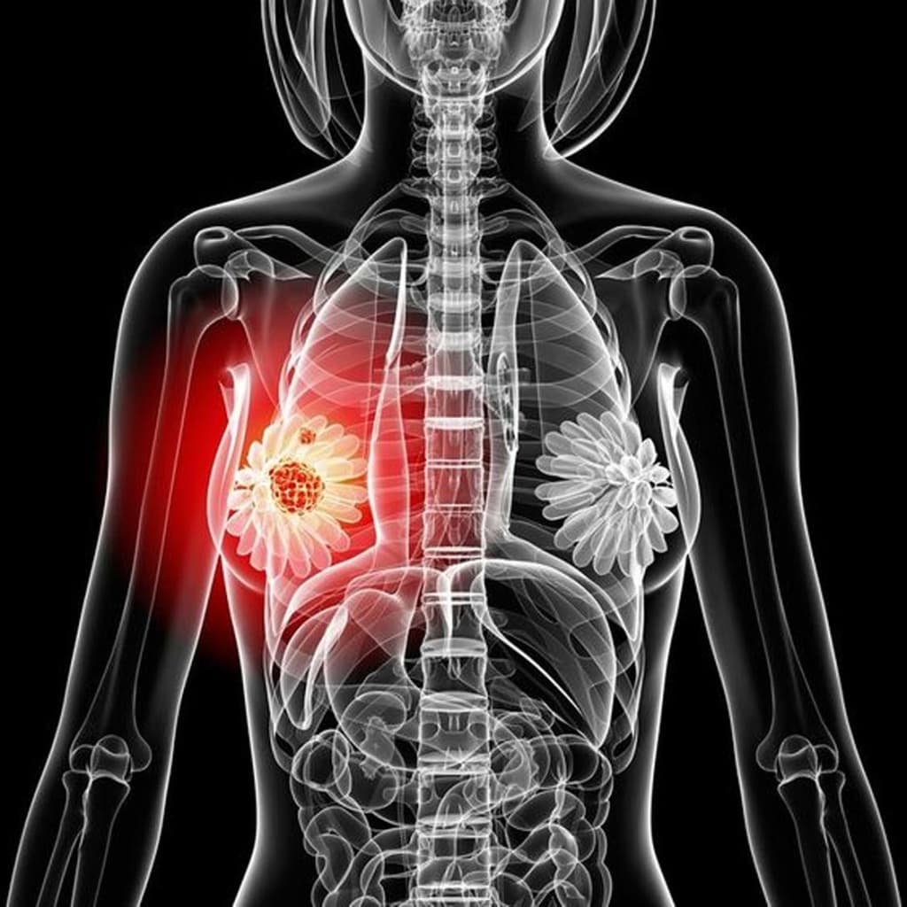 рак молочной железы